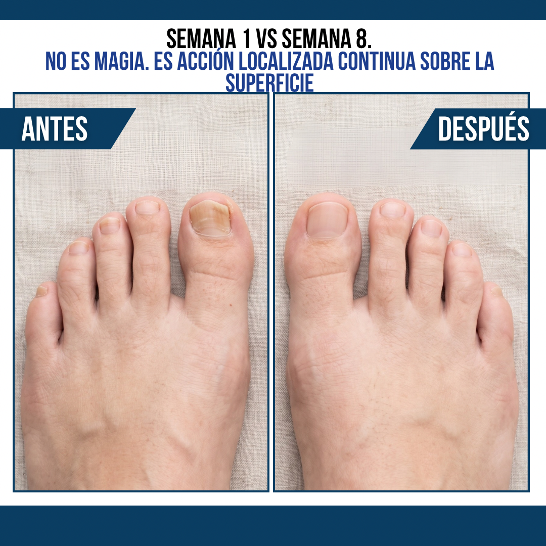 2x1 SÉRUM ANTIHONGOS PARA UÑAS PURAVIA™