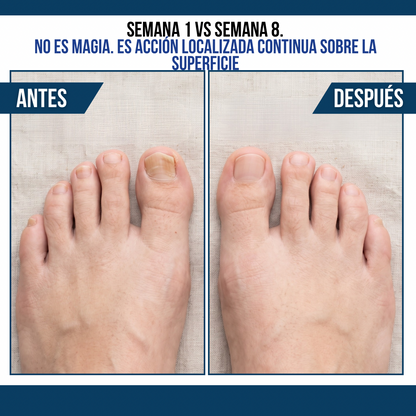 2x1 SÉRUM ANTIHONGOS PARA UÑAS PURAVIA™